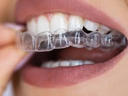 Impronta digitale con scanner intraorale per bite personalizzato