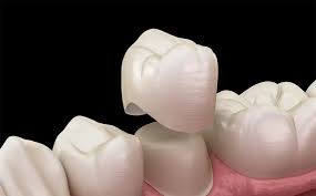 Esempio di corona e ponte su modello dentale