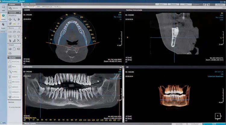 Impianto dentale e chirurgia guidata