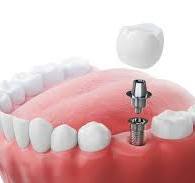 Protesi fissa su impianti