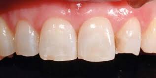 Protezione dei denti con bite notturno